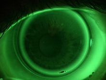 Conseils d'ophtalmo pour les lentilles de contact